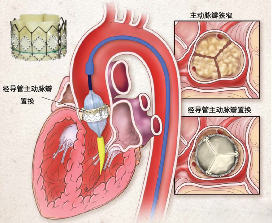 主动脉瓣狭窄杂音图片