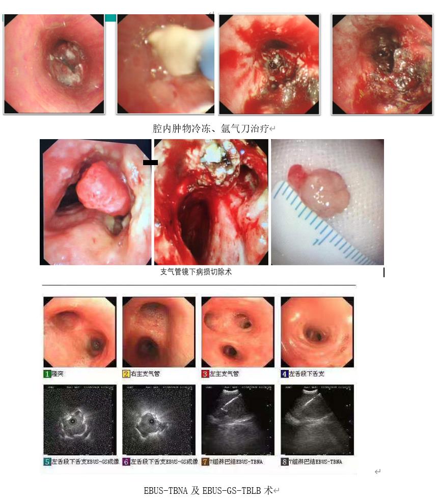 呼吸气管镜介入技术2 6a46b